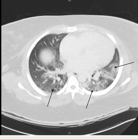 Computed Tomography Ct Scan Of The Chest Showing Bilateral Patchy