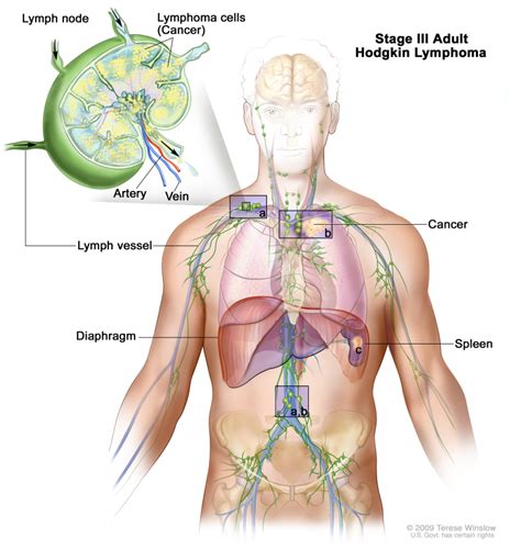Figure Stage Iii Adult Hodgkin Lymphoma Pdq Cancer Information Summaries Ncbi Bookshelf