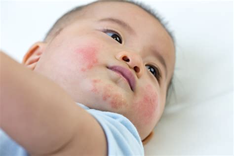 Baby Eczema Rash On Face