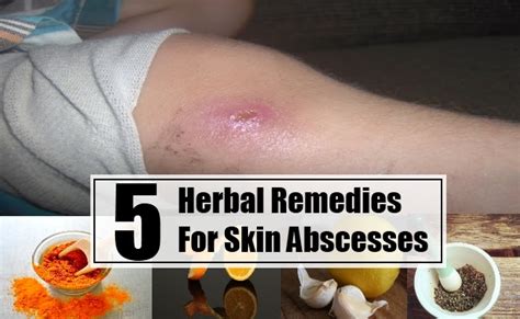 5 Herbal Remedies For Skin Abscesses Mzizi Mkavu