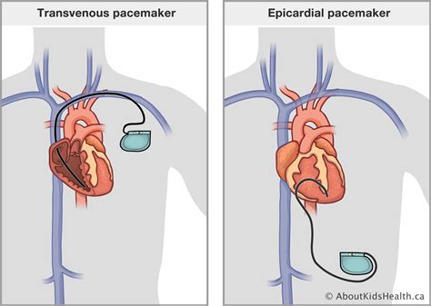 Pacemaker Surgery