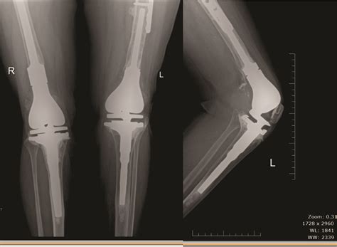 Distal Femoral Fractures Complications And How To Avoid Them Trauma