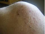 Eczema On Back Of Knees Treatment Pictures