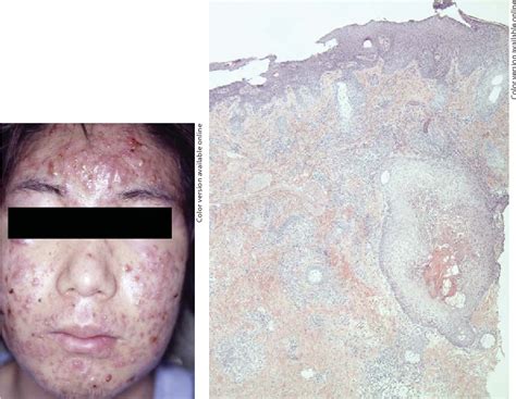 Figure 2 From A Case Of Acne Fulminans In A Patient With Ulcerative
