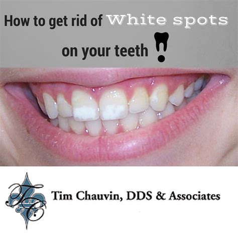 How To Get Rid Of White Spots On Your Teeth Dr Chauvin