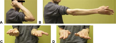 Terrible Triad Injuries Of The Elbow Journal Of Hand Surgery