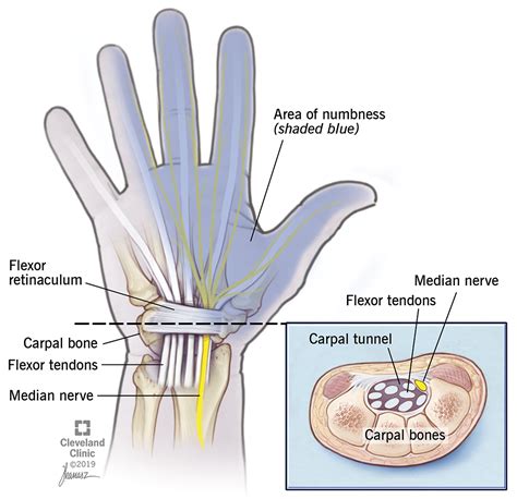 Carpal Tunnel Syndrome Risk Factors Symptoms And Treatment