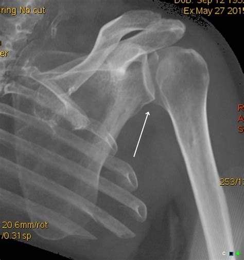 Posterior Fracture Dislocation Glenohumeral Joint Reverse Hill Sachs