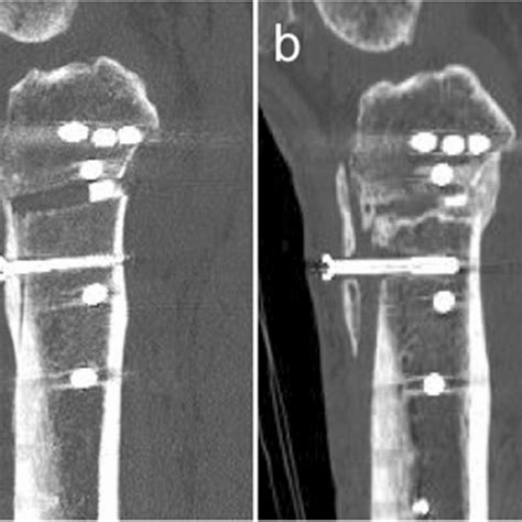 A Case Of 60 Year Old Male With Postoperative Fracture Of The Tibial