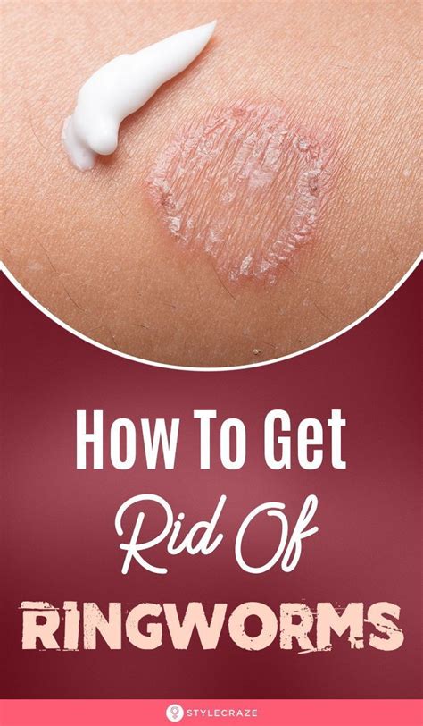 15 Best Home Remedies To Get Rid Of Ringworms Prevent Tips