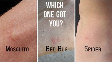 Bed Bug Bites What You Need To Know Bedbugs