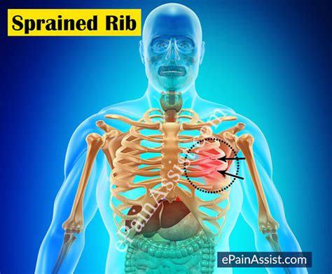 You need to undergo radio imaging (mri/ct). Sprained Rib|Causes|Symptoms|Treatment|Exercises|Diagnosis