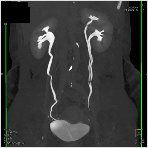 Ct Urogram With Duplicated Collecting System On The Left Kidney Case