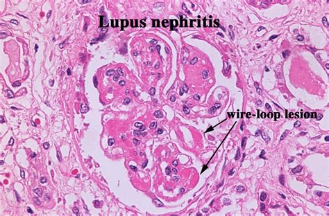 Diffuse Proliferative Glomerulonephritis Pathology Renal Kidney Biopsy