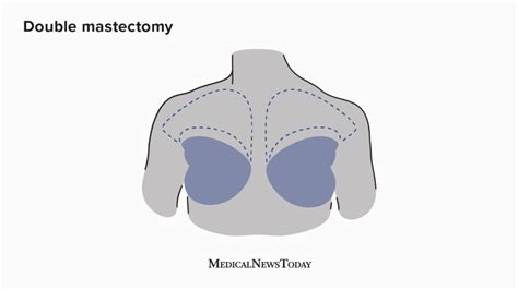 Mastectomy Types Uses And Procedure