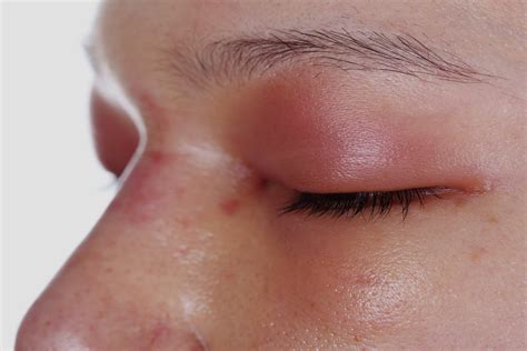 Rosácea Ocular O Que é Sintomas E Tratamento Tua Saúde