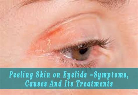 Know Everything About Peeling Eyelids Including Its Causes Treatments Eczema On Eyelids Dry