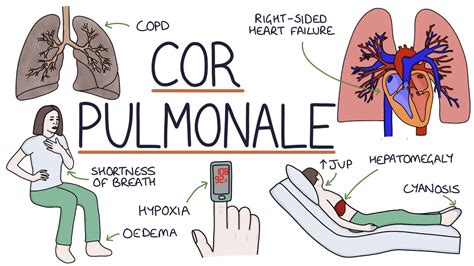 Understanding Cor Pulmonale Youtube