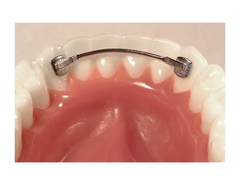 Lingual Appliances American Orthodontics