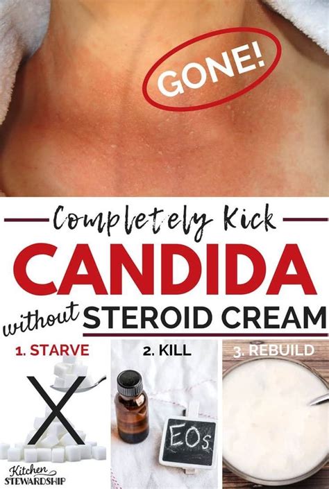candida symptoms naturopath vs m d about the surprise rash candida symptoms candida