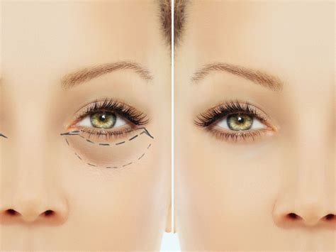 Blepharoplasty Eyelid Surgery What It Is And Post Op Treatment