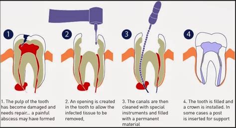 After having the treatment, all your issues like sensitivity, pain, and bleeding if any would. Root Canal Procedures Can Save Teeth in Mississauga | St ...