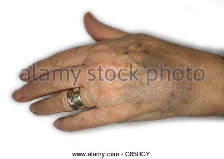 Elderly Woman Bruised Hand Stock Photo: 39466143 - Alamy