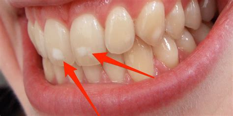White Spots On Teeth Are Related To Childhood Health Business Insider