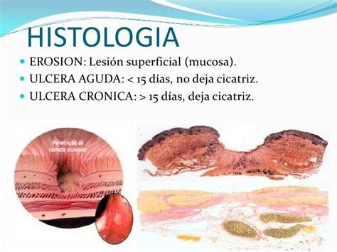 Frammenti Di Mucosa Gastrica Di Tipo Antrale E Fundico - Ulcera PéPtica GáStrica
