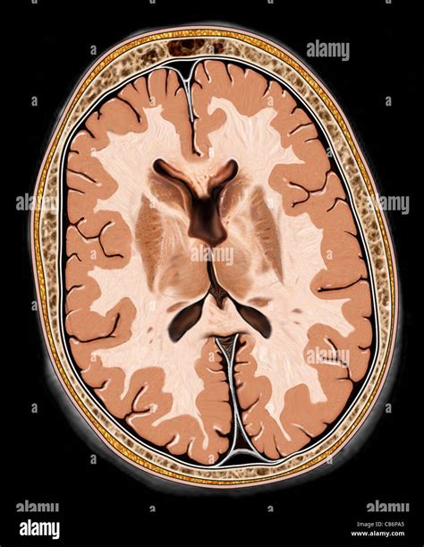 This Medical Illustration Features An Axial View Of The Brain Stock