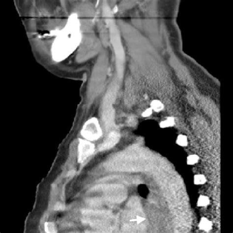Sagittal Ct Scan Shows Abnormal Finding Of The Oesophagus Arrows