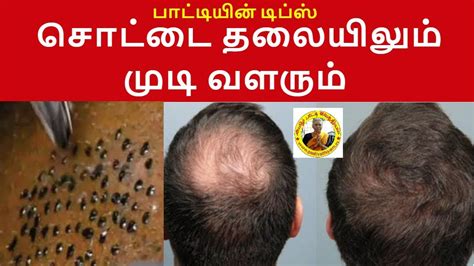 Excessive hair loss causes bald patches on your head, receding hairline and sometimes complete baldness.it can be deeply distressing and can make your feel awkward. சொட்டை தலையிலும் முடி வளரும் Tips for Hair Growth bald ...