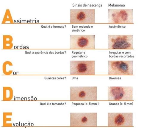 Câncer de pele Fotos Imagens Vídeos e Tratamento