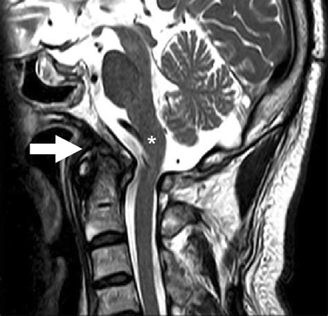 The T2 Weighted Magnetic Resonance Imaging Of The Cervical Spine In The