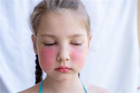Facial Swelling Allergy Stock Photos Free And Royalty Free Stock Photos