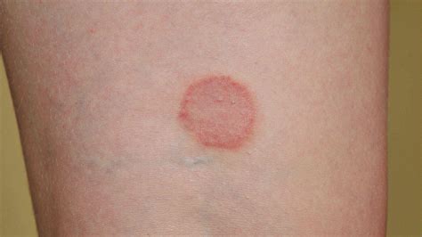 Pityriasis Rosea Stages Causes And Treatment Health Blog