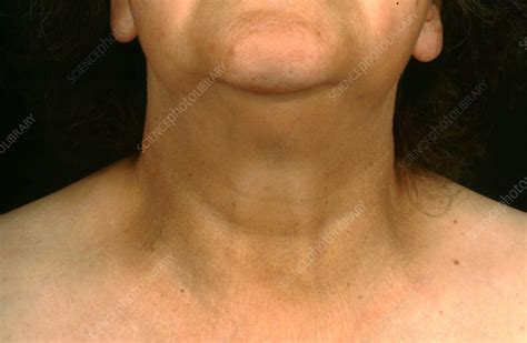 Hypothyroidism Swollen Neck Stock Image C036 5590 Science Photo