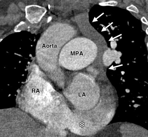 This article covers the anatomy and location of the cavernous sinus and helps you to understand the location and anatomy. Imaging of the Coronary Sinus: Normal Anatomy and ...