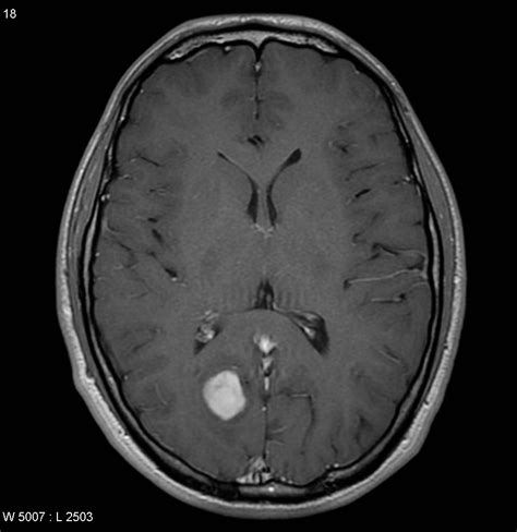 What Is About Brain Tumor