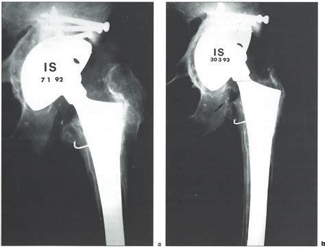 Figure 1 From Cementless Revision For Failed Cemented Total Hip