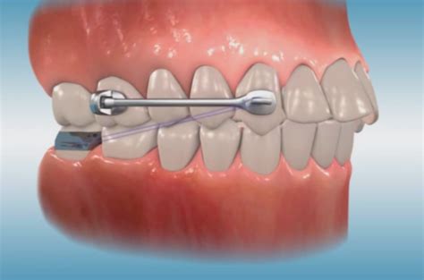 Cooke Orthodontics Carriere® Motion™ Class Ii Appliance