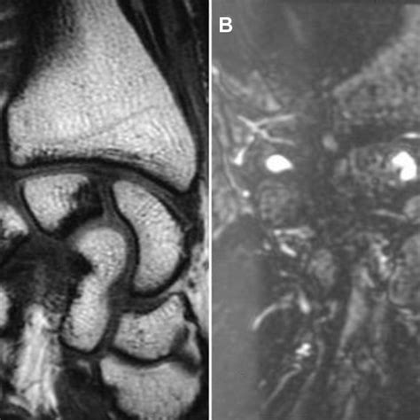 PDF Arthroscopic Treatment Of Intraosseous Ganglion Cyst Of The Lunate Bone