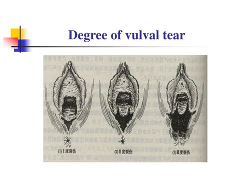 Ppt Post Partum Hemorrhage Uterine Rupture Powerpoint Presentation