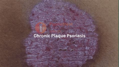 Chronic Plaque Psoriasis Treatment Guidelines A Case Study Psoriasis