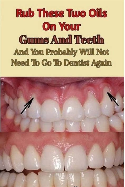 Rub These Two Oils On Your Gums And Teeth Interesting Minds Teeth