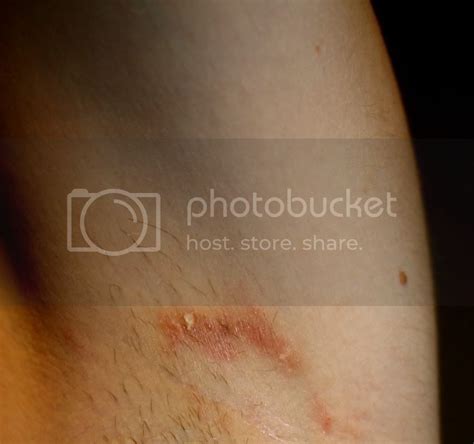 Red Mark Under Armpit Pictures Photos