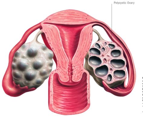 Polycystic Ovary Syndrome Pcos Treatment Sunshine Coast And Bundaberg