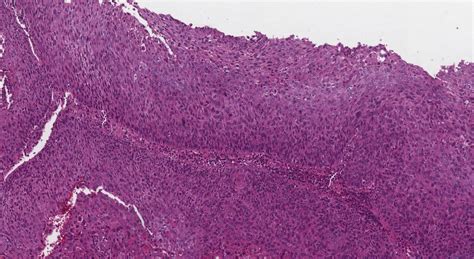 Hpv Associated Squamous Cell Carcinoma Of The Larynx Atlas Of Pathology