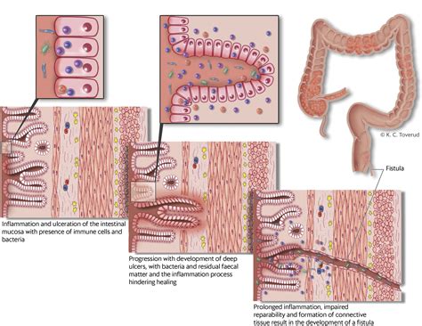 Medical Management Of Fistulising Crohn S Disease Tidsskrift For Den Norske Legeforening