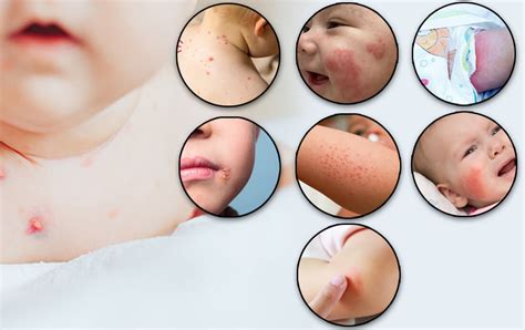 Skin Rash Identification Chart Symptoms In Children